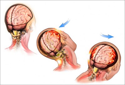 Brain-Injury