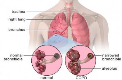 copd-01