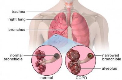 copd-01