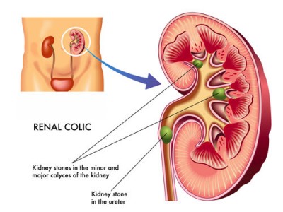 Kidney Ston