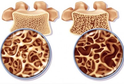 Osteoporosis