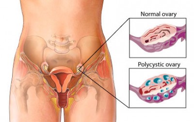 Ovary-Multiple Cyst