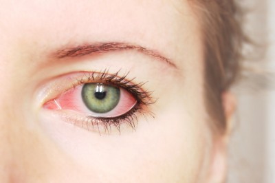 Pink-Eye-(Conjuctivitis)