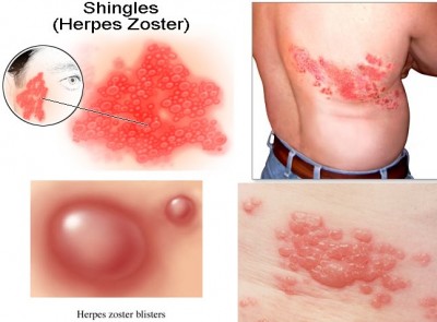 Shingles-Sign-and-Symptoms