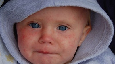 child-with-rubella