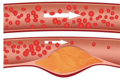 cholesterol-01