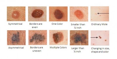 melanoma