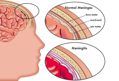 meningitis01