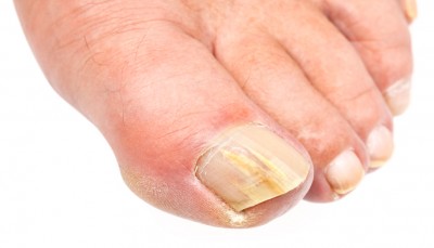 toe-fungus