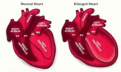 Broken heart Syndrome