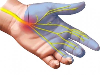 Carpal-Tunnel syndrome