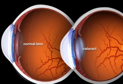 Cataract