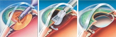 cataract surgery