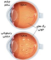 مقایسه ته چشم سالم و چشم فرد مبتلا به دیابت و آسیب شبکیه 