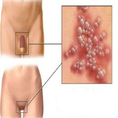 هنگامی‌که علایم در موارد نادر بروز کنند، عفونت سوزاک بر چندین محل از بدن تاثیر می‌گذارد، اما معمولا در دستگاه تناسلی ظاهر می‌شود.