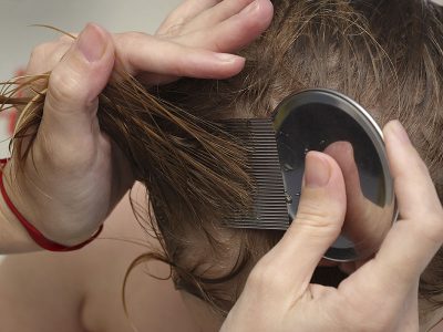 شانه کردن موهای خیس با شانه دندانهریز مخصوص نیت ممکن است شپش و برخی نیتها را از بین ببرد