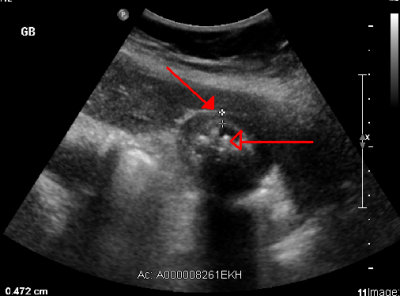 آزمایشات تصویربرداری مانند سونوگرافی شکمی یا توموگرافی کامپیوتری (CT) اسکن برای ایجاد تصاویر کیسه صفرا انجام می‌شوند تا نشانه‌ای از کوله سیستیت را آشکار کنند