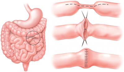 در طول عمل، جراح بخش آسیب‌دیده از دستگاه گوارش را جدا می‌کند و سپس بخشهای سالم را دوباره به هم پیوند می‌دهد