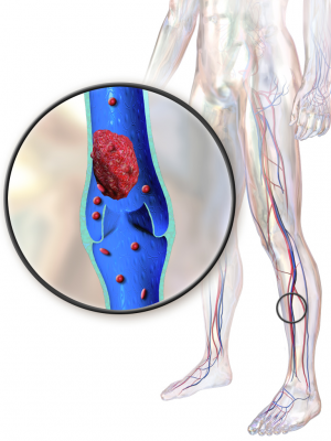 ترومبوز ورید عمقی (DVT) هنگامی رخ می‌دهد که لخته خون (ترومبوز) در یک یا چند ورید عمقی معمولاً در پاها شکل می‌گیرد