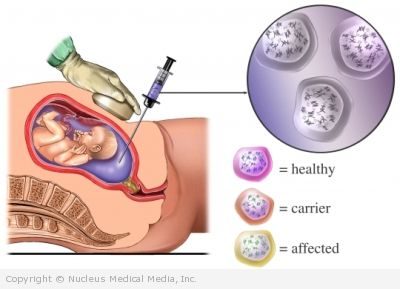 نمونهای از مایع آمنیوتیک پیرامون جنین از طریق سوزنی که در رحم مادر فرو رفته بیرون کشیده می‌شود. این نمونه سپس برای تجزیه و تحلیل کروموزوم جنین استفاده می‌شود