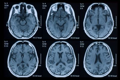 تصویربرداری رزونانس مغناطیسی (MRI): در این روش، از آهنربای قوی و امواج رادیویی برای ایجاد دورنمایی دقیق از مغز بهرهگیری میشود. این آزمایش ممکن است بعد از تثبیت کردن وضعیت بالینی فرد انجام شود