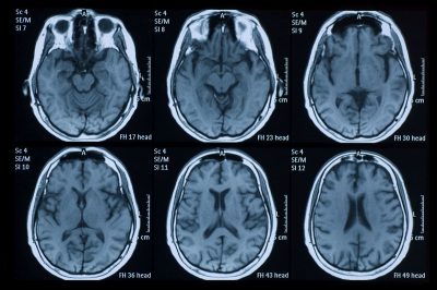 تصویربرداری رزونانس مغناطیسی (MRI): در این روش، از آهنربای قوی و امواج رادیویی برای ایجاد دورنمایی دقیق از مغز بهره‌گیری ‌می‌شود. این آزمایش ممکن است بعد از تثبیت کردن وضعیت بالینی فرد انجام شود