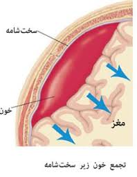 فضای ساب آراکنوئید یا زیر عنکبوتیه، ناحیه ای بین دو پرده پوشاننده مغز است که به طور طبیعی با مایع مغزی ـ نخاعی پر می شود. خونریزی در این ناحیه، یکی از انواع سکته مغزی به شمار می آید و عواقب جدی از جمله فلج، کما و مرگ به همراه دارد.