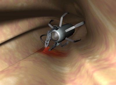 درمان بیماری التهابی روده با کپسول های هوشمند