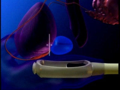 نیروی ماوراء صوت در این دستگاه از یک سطح محدب ساطع و در یک نقطه کانونی متمرکز می شود. در نتیجه در آن نقطه حرارت فوق العاده زیادی ایجاد و بافت سرطانی از بین می رود.