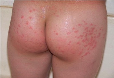 زخم در مردان و زنان بر روی نواحی زیر از بدن رشد می‌کند: باسن مقعد دهان