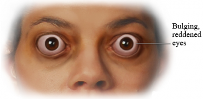 بیرون‌زدگی چشم